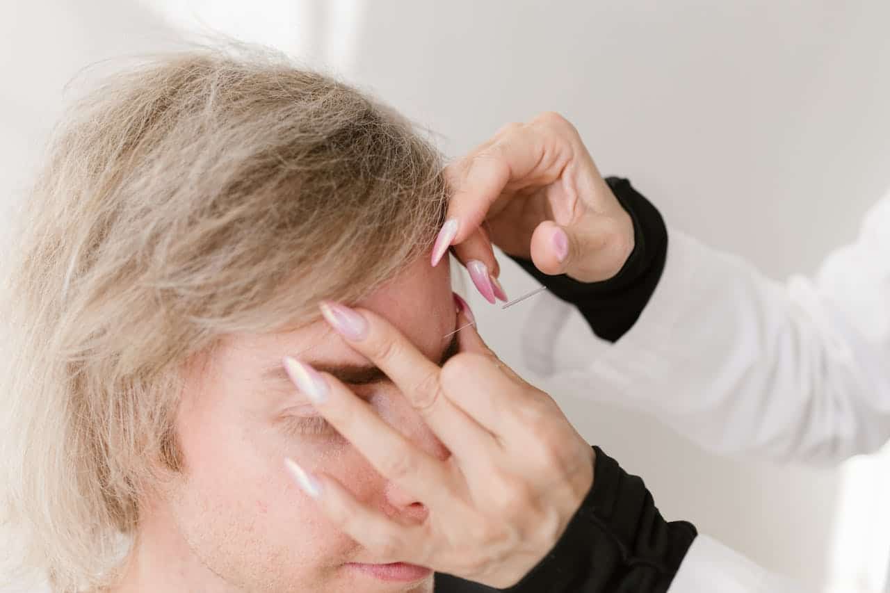 Man Getting an Acupuncture